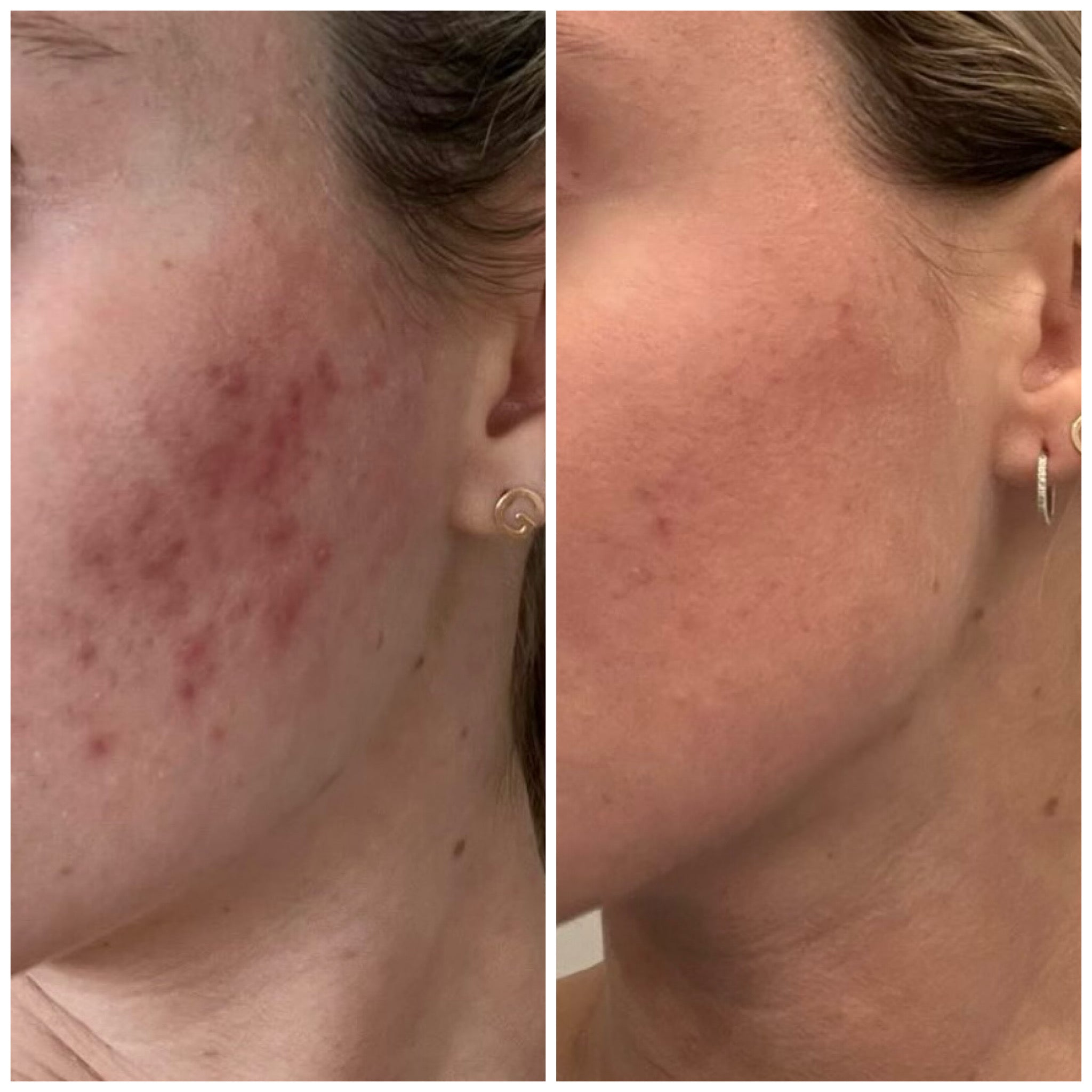 RF Microneedling (VoluDerm)